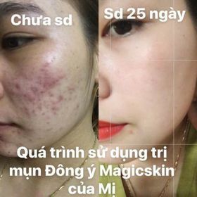 BỘ TRỊ MỤN ĐÔNG Y TRỊ MỤN ẨN – MỤN BỌC – MỦ – TRỨNG CÁ- MAGIC SKIN giá sỉ